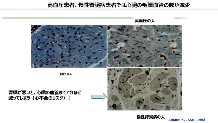 視覚で知る心臓の血管の減少